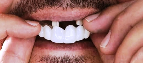 لمینت متحرک دندان